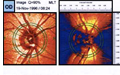 Glaucoma Diagnostics